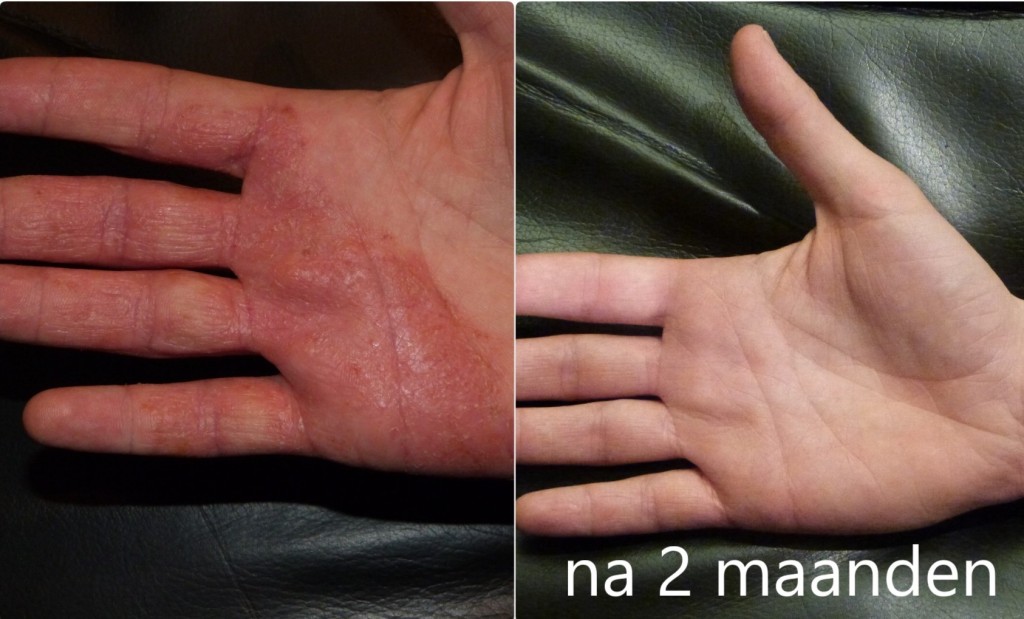 Dermatitis-voor-en-na-2-maanden
